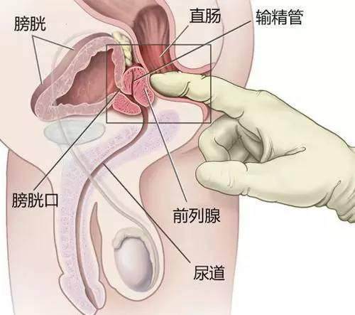 前列腺液的检查对诊断前列腺疾病有何意义？