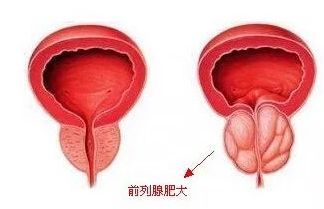 为什么前列腺肥大的病人也可以进行耳穴按摩？