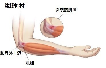 为什么网球肘也可以配合耳穴按摩进行治疗？