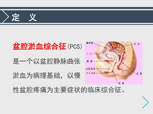 盆腔瘀血综合征的临床表现有哪些?