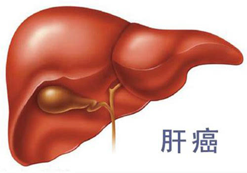 为什么肝癌患者早期诊断很重要？