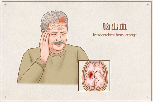 为什么对脑出血病人手术疗法是选择好适应证?