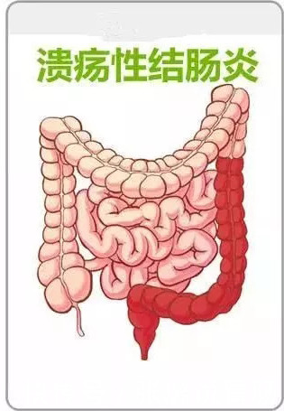 哪些症状提示患了溃疡性结肠炎?