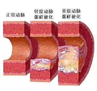 中医如何治疗动脉粥样硬化？